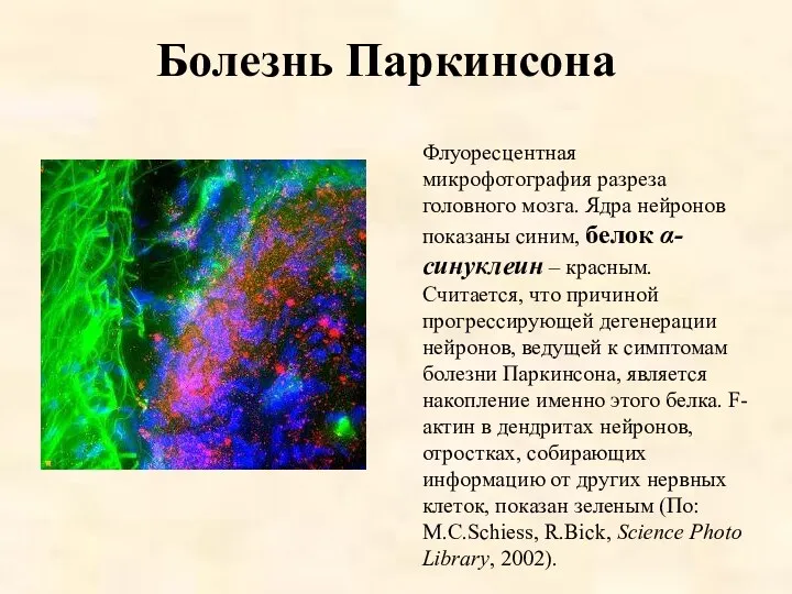 Болезнь Паркинсона Флуоресцентная микрофотография разреза головного мозга. Ядра нейронов показаны