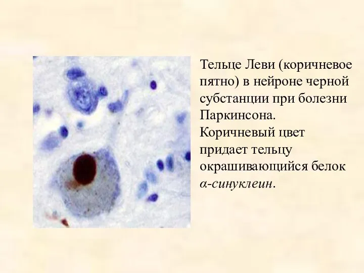 Тельце Леви (коричневое пятно) в нейроне черной субстанции при болезни