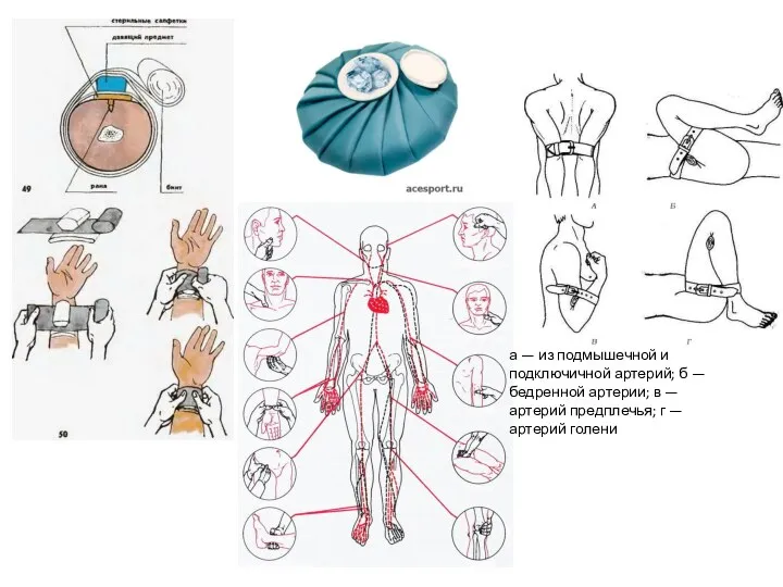 а — из подмышечной и подключичной артерий; б — бедренной