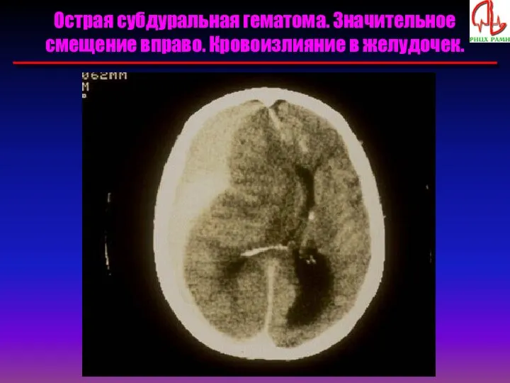 Острая субдуральная гематома. Значительное смещение вправо. Кровоизлияние в желудочек.