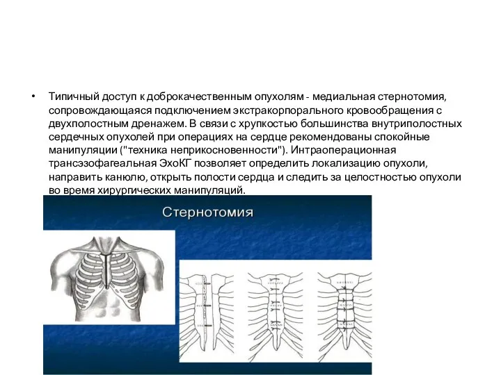 Типичный доступ к доброкачественным опухолям - медиальная стернотомия, сопровождающаяся подключением