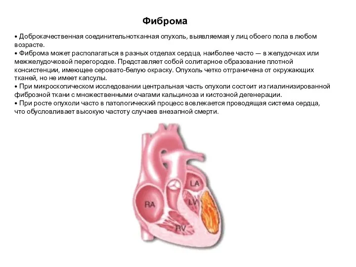 Фиброма • Доброкачественная соединительнотканная опухоль, выявляемая у лиц обоего пола