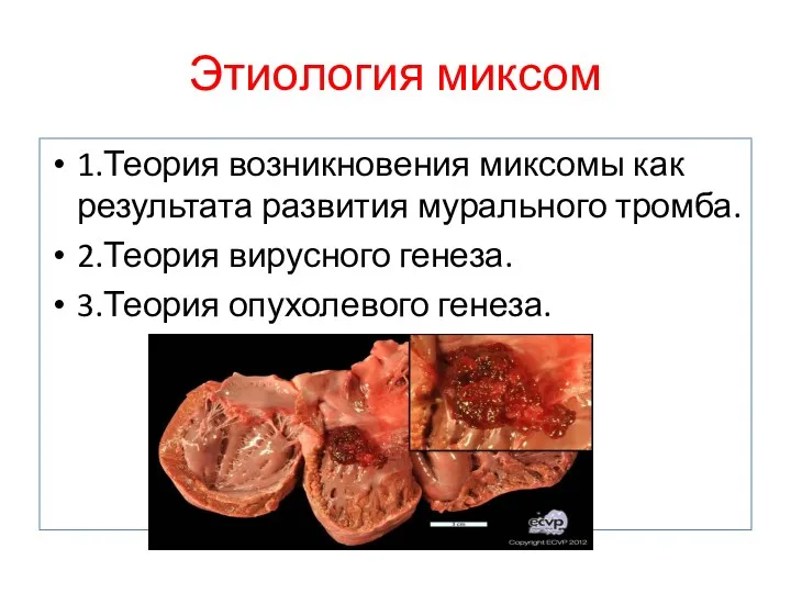 Этиология миксом 1.Теория возникновения миксомы как результата развития мурального тромба. 2.Теория вирусного генеза. 3.Теория опухолевого генеза.