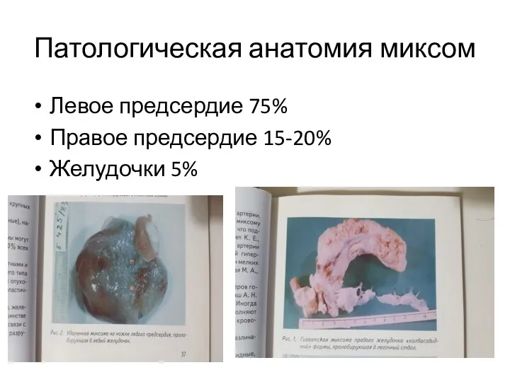 Патологическая анатомия миксом Левое предсердие 75% Правое предсердие 15-20% Желудочки 5%