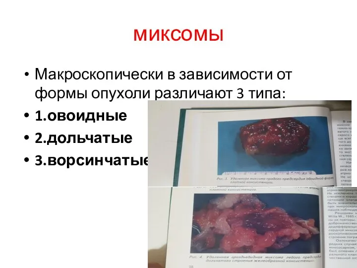 миксомы Макроскопически в зависимости от формы опухоли различают 3 типа: 1.овоидные 2.дольчатые 3.ворсинчатые