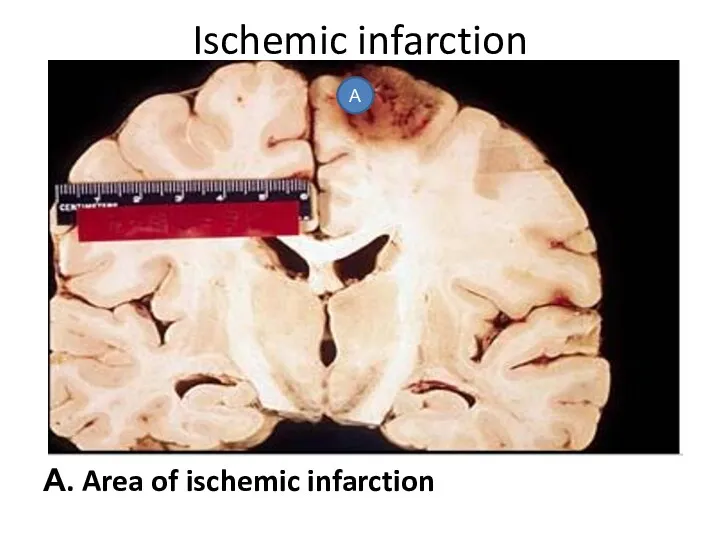 А. Area of ischemic infarction Ischemic infarction А