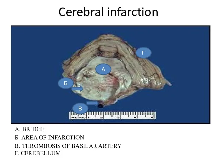 Cerebral infarction А. BRIDGE Б. AREA OF INFARCTION В. THROMBOSIS