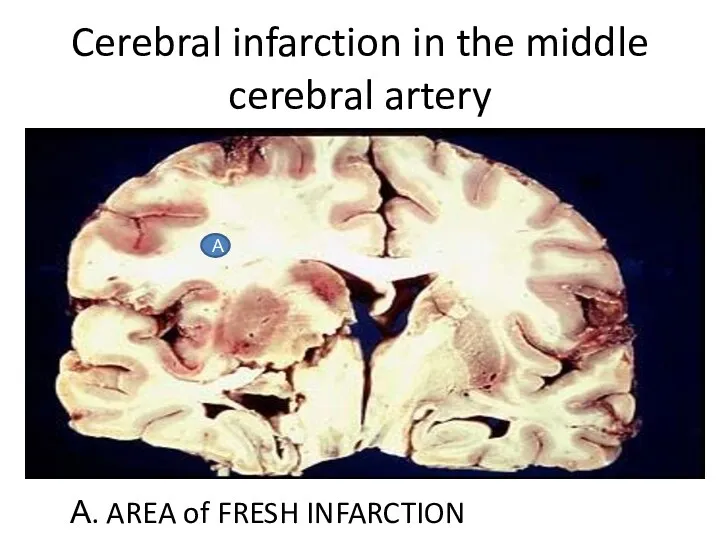 Cerebral infarction in the middle cerebral artery А. AREA of FRESH INFARCTION А