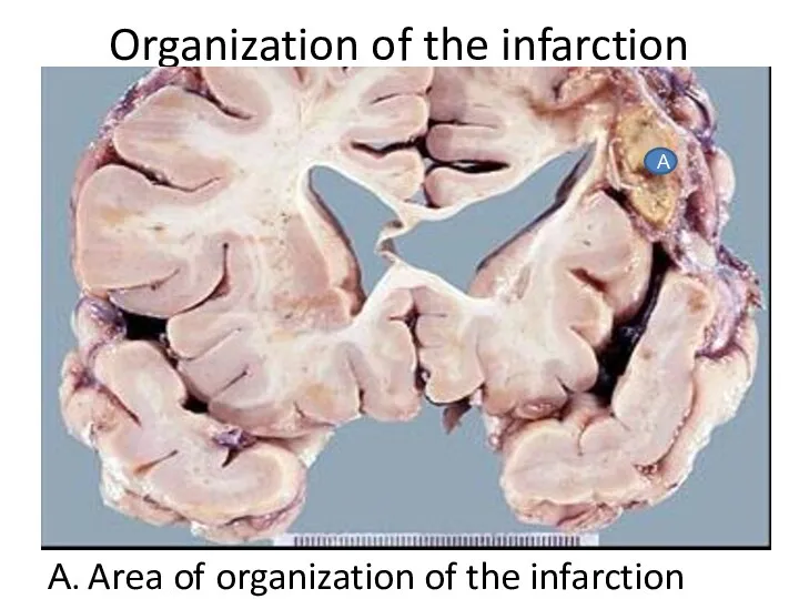 Organization of the infarction А. Area of organization of the infarction А