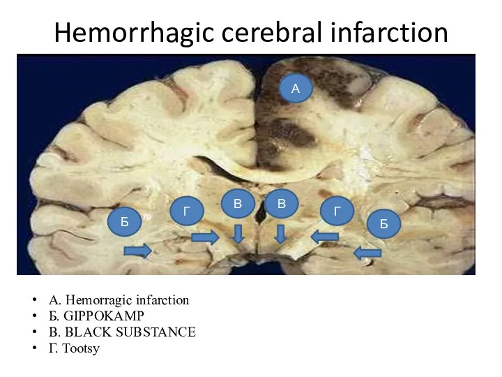 Hemorrhagic cerebral infarction А. Hemorragic infarction Б. GIPPOKAMP В. BLACK