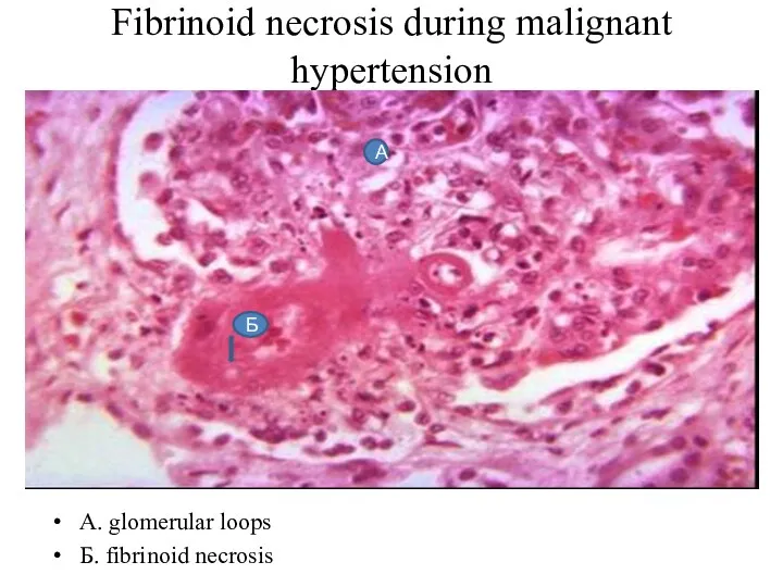 Fibrinoid necrosis during malignant hypertension А. glomerular loops Б. fibrinoid necrosis Б А