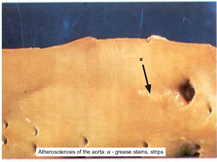 а Atherosclerosis of the aorta: a - grease stains, strips