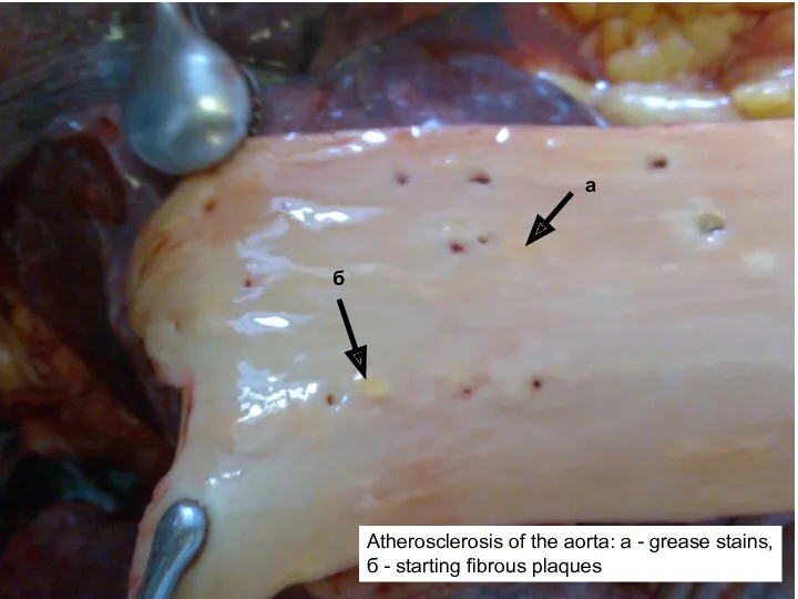 Atherosclerosis of the aorta: a - grease stains, б - starting fibrous plaques а б