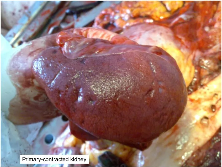 Primary-contracted kidney