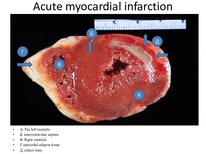 Acute myocardial infarction A. The left ventricle Б. interventricular septum