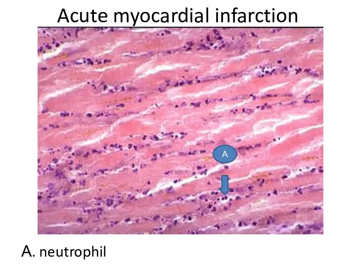 Acute myocardial infarction А. neutrophil А
