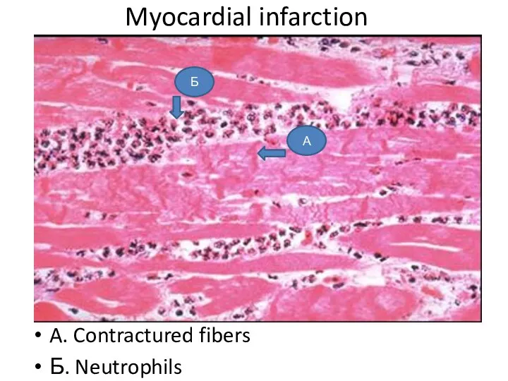 A. Contractured fibers Б. Neutrophils Myocardial infarction А Б