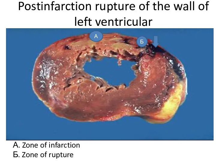 Postinfarction rupture of the wall of left ventricular А. Zone