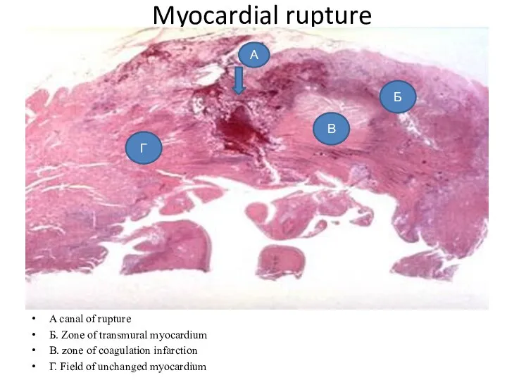 Myocardial rupture A canal of rupture Б. Zone of transmural