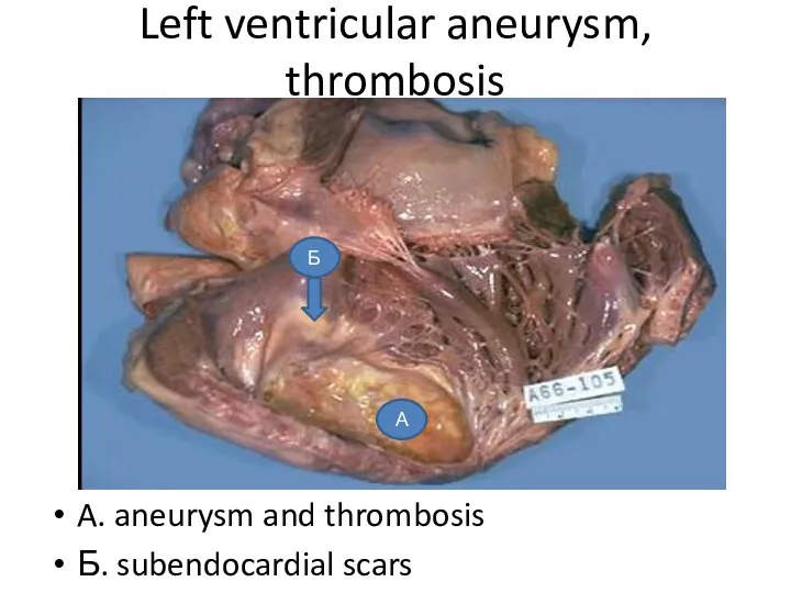 Left ventricular aneurysm, thrombosis A. aneurysm and thrombosis Б. subendocardial scars А Б