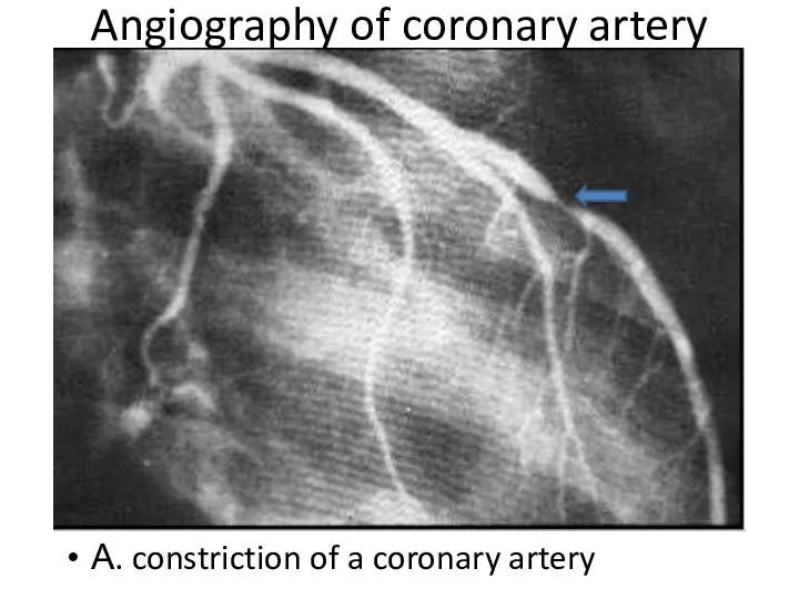 Angiography of coronary artery А. constriction of a coronary artery