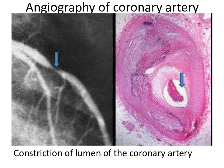 Angiography of coronary artery Constriction of lumen of the coronary artery