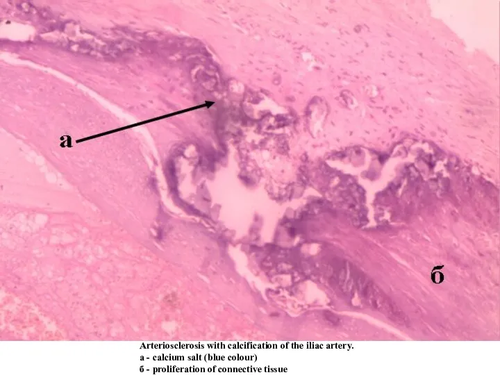 Arteriosclerosis with calcification of the iliac artery. a - calcium