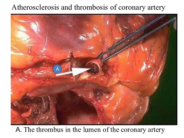 Atherosclerosis and thrombosis of coronary artery А. The thrombus in