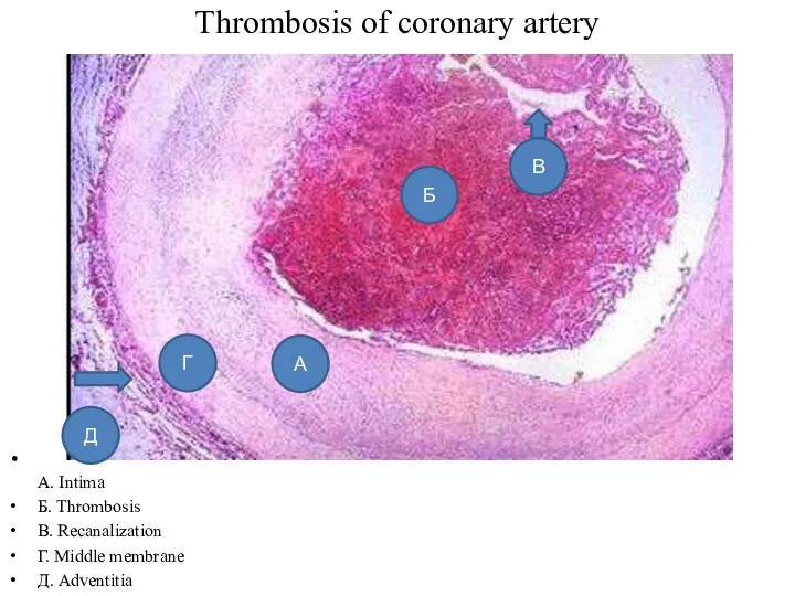 Thrombosis of coronary artery A. Intima Б. Thrombosis B. Recanalization