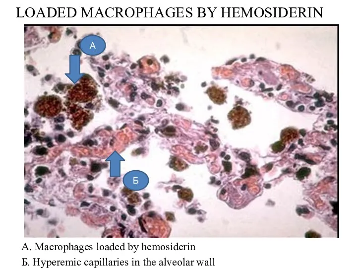 LOADED MACROPHAGES BY HEMOSIDERIN A. Macrophages loaded by hemosiderin Б.