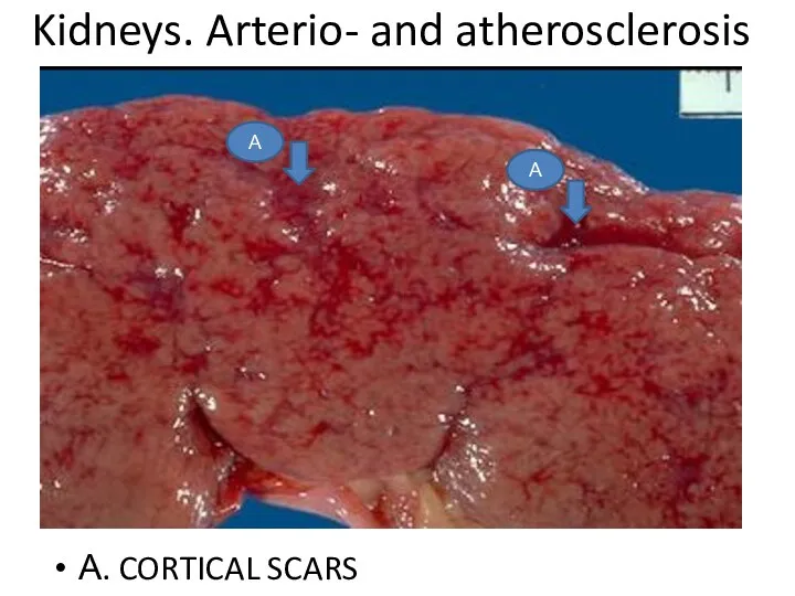 Kidneys. Arterio- and atherosclerosis А. CORTICAL SCARS А А