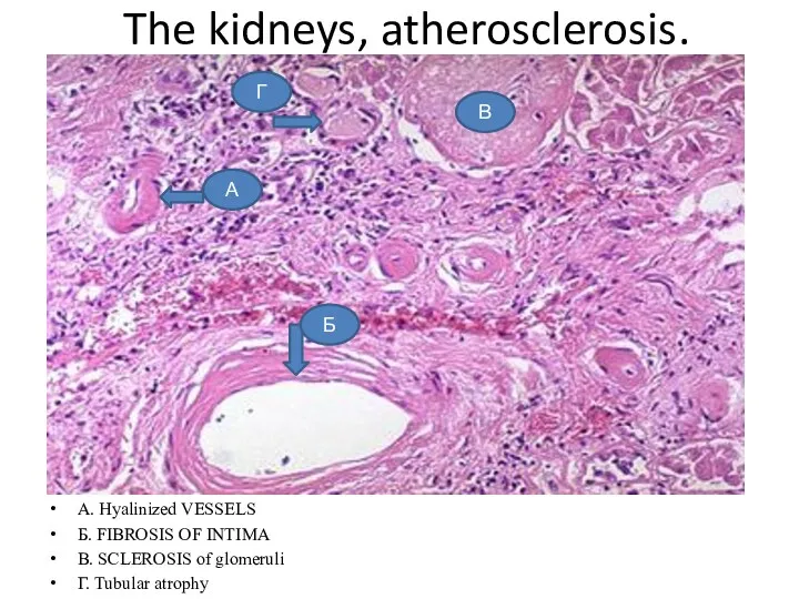 The kidneys, atherosclerosis. A. Hyalinized VESSELS Б. FIBROSIS OF INTIMA