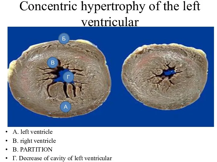 Concentric hypertrophy of the left ventricular A. left ventricle B.