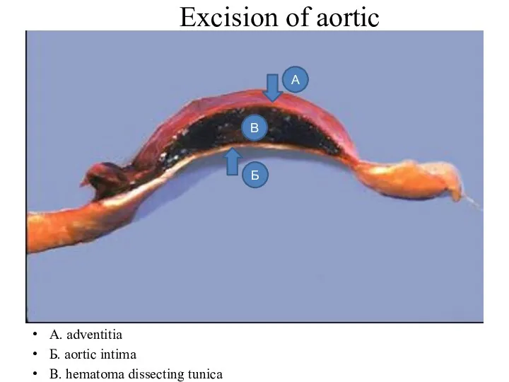 Еxcision of aortic A. adventitia Б. aortic intima B. hematoma dissecting tunica А Б В