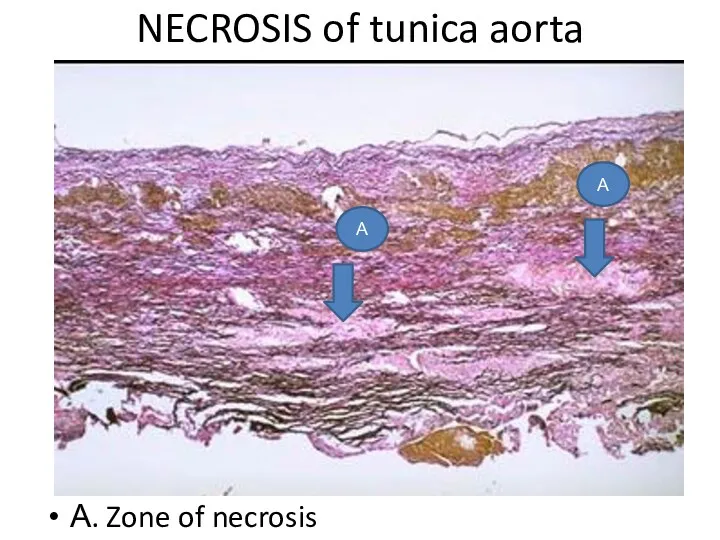 NECROSIS of tunica aorta А. Zone of necrosis А А
