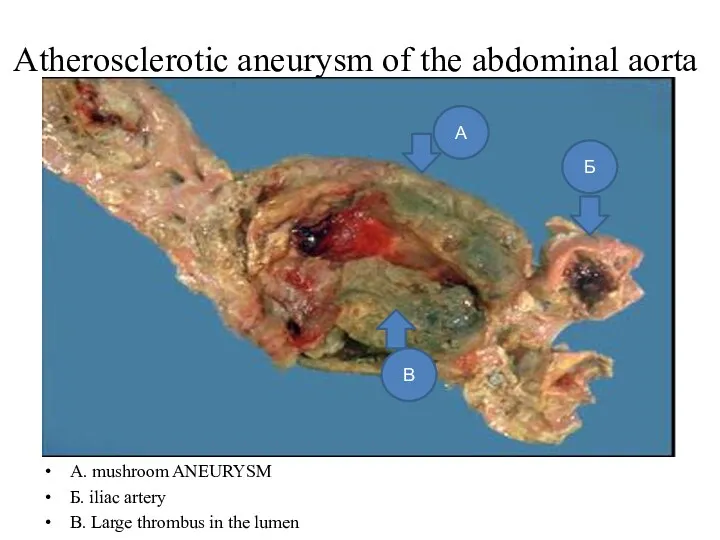 Atherosclerotic aneurysm of the abdominal aorta A. mushroom ANEURYSM Б.