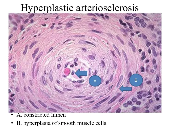 Hyperplastic arteriosclerosis A. constricted lumen B. hyperplasia of smooth muscle cells А Б