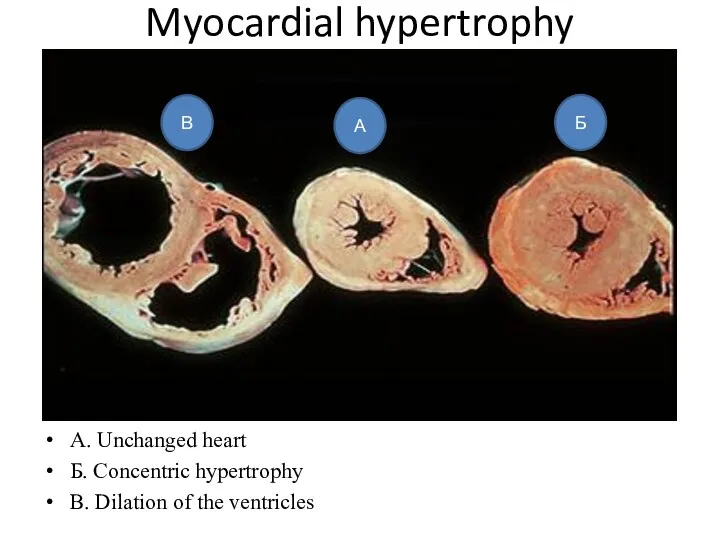 Myocardial hypertrophy A. Unchanged heart Б. Concentric hypertrophy B. Dilation of the ventricles В А Б