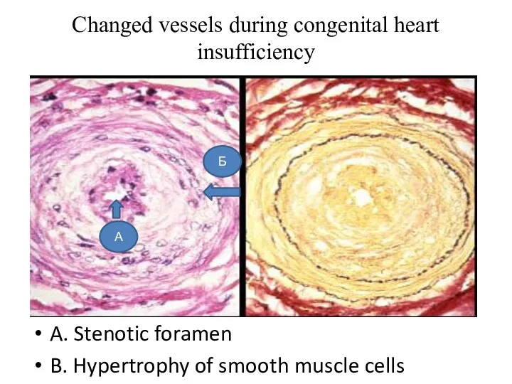 Сhanged vessels during congenital heart insufficiency A. Stenotic foramen B.