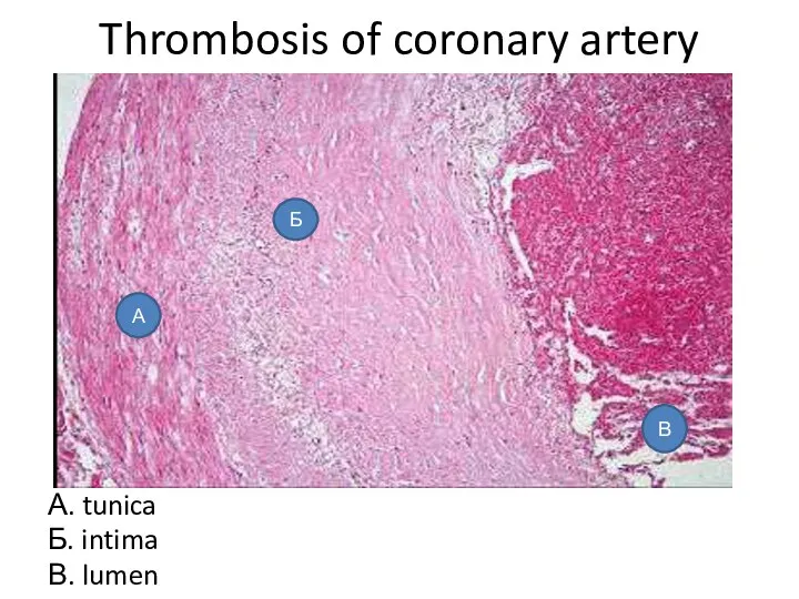 Thrombosis of coronary artery А. tunica Б. intima В. lumen В Б А