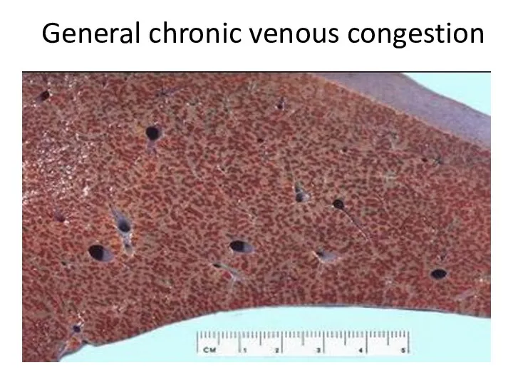 General chronic venous congestion