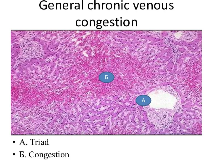 General chronic venous congestion A. Triad Б. Congestion А Б