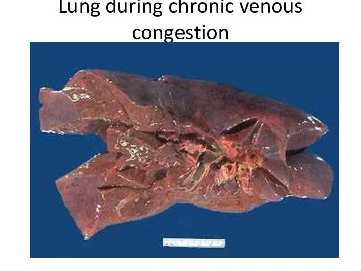 Lung during chronic venous congestion