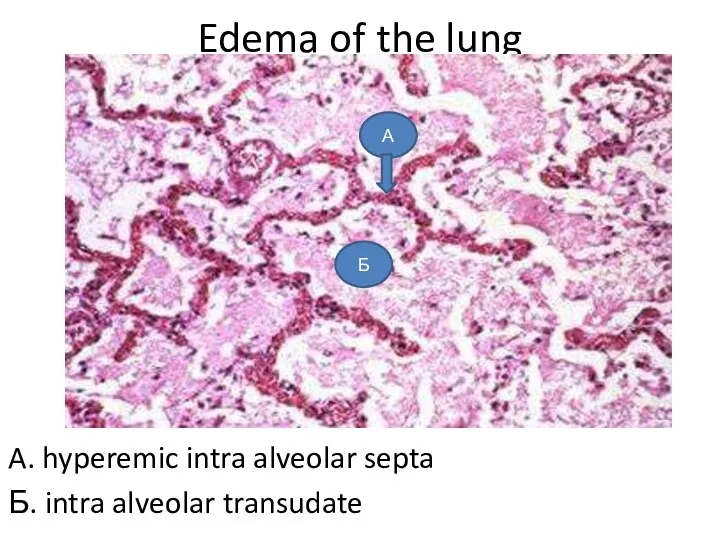 Edema of the lung A. hyperemic intra alveolar septa Б. intra alveolar transudate А Б