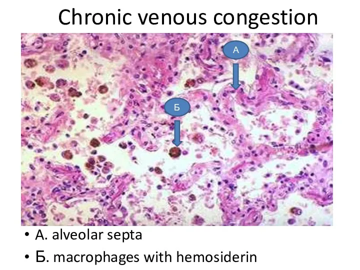 Chronic venous congestion A. alveolar septa Б. macrophages with hemosiderin А Б
