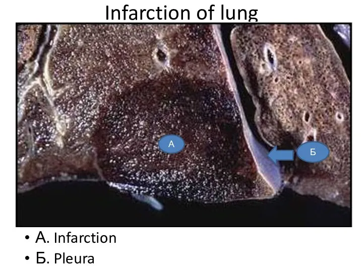 Infarction of lung А. Infarction Б. Pleura Б А