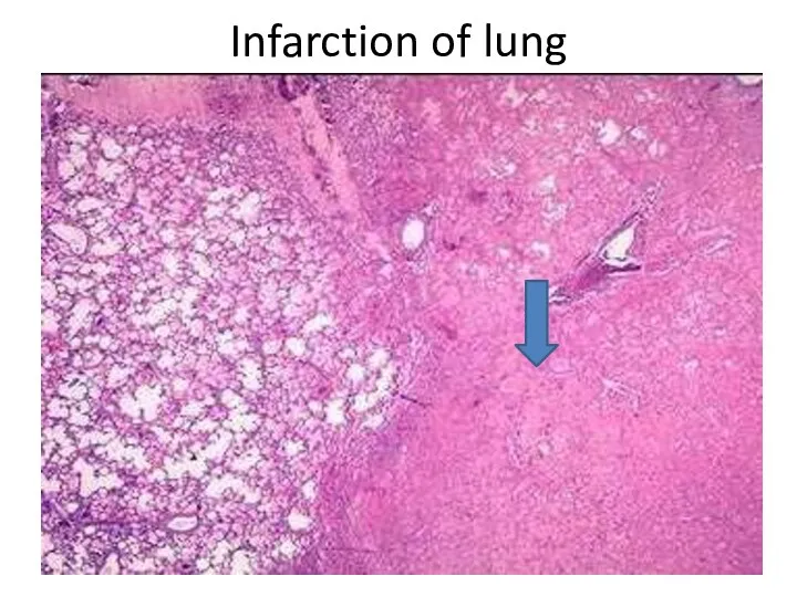 Infarction of lung