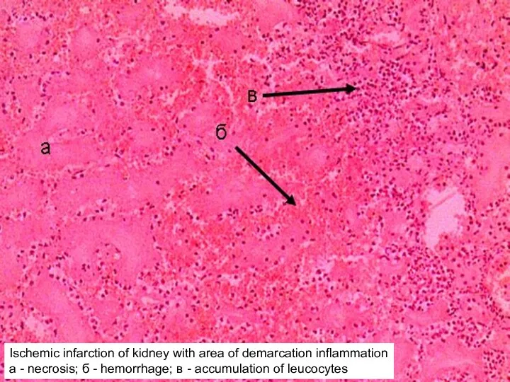 Ischemic infarction of kidney with area of demarcation inflammation a