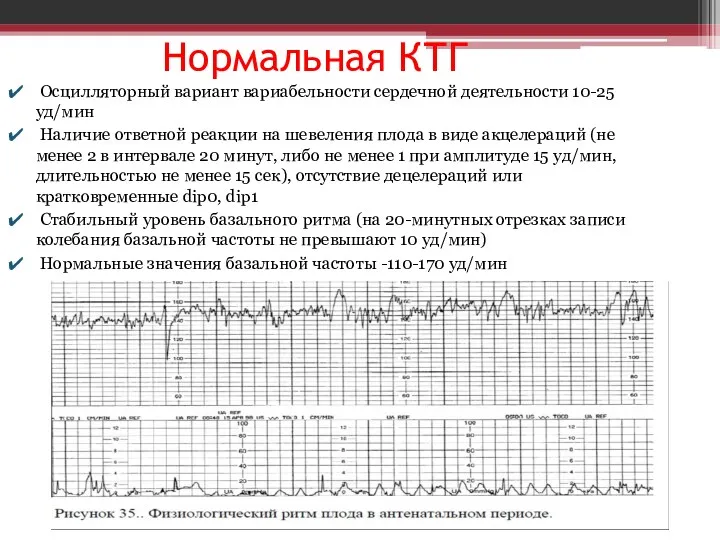 Нормальная КТГ Осцилляторный вариант вариабельности сердечной деятельности 10-25 уд/мин Наличие ответной реакции на