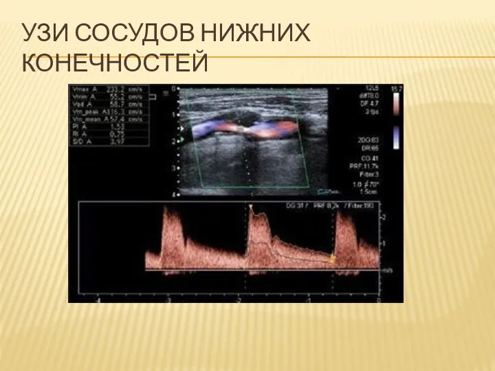 УЗИ СОСУДОВ НИЖНИХ КОНЕЧНОСТЕЙ